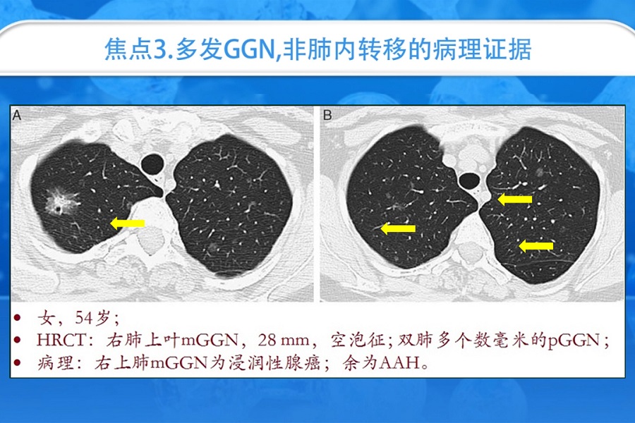 《结核和呼吸科频道》2019年第4讲（总第38讲）磨玻璃结节解读及指南进展（4）